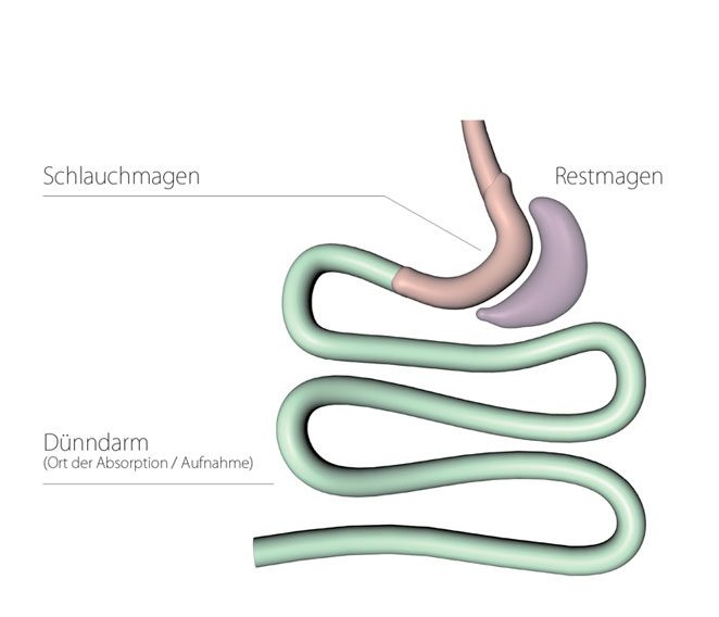 Grafische Darstellung Schlauchmagen (Gastric Sleeve Resection) 