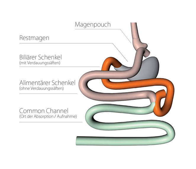 Grafische Darstellung Magenbypass (Proximaler Magenbypass)